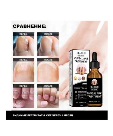 Eelhoe solution for the treatment of nail fungus - Buy Online on GoSupps.com