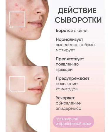 BeautyCevtika Facial serum from acne and post -acne with retinol - Buy Online on GoSupps.com