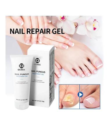 Ouhoe gel to care for nail fungus