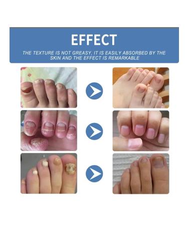 Ouhoe gel to care for nail fungus - Buy Online on GoSupps.com