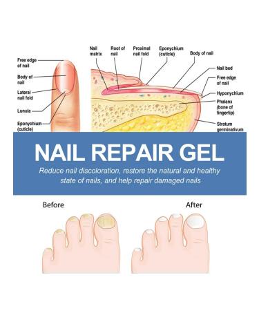 Ouhoe gel to care for nail fungus - Buy Online on GoSupps.com