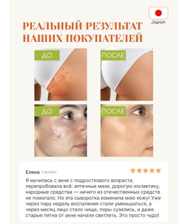 Tokishi LV Acne acne cream serum - Buy Online on GoSupps.com