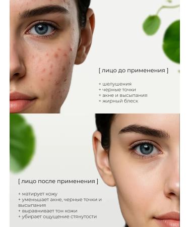 Yar'Co Gel for washing from acne 100 grams - Buy Online on GoSupps.com