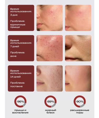 Fil Ji Permis from acne and black dots for skin and body skin - Buy Online on GoSupps.com