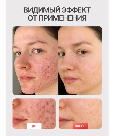 Waski Anti-acne and post-acne cream - Buy Online on GoSupps.com