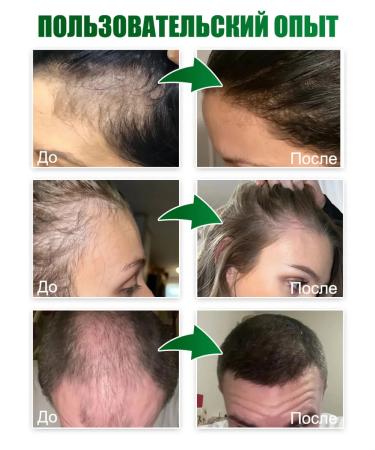 Disaar Hair loss to grow hair - Buy Online on GoSupps.com