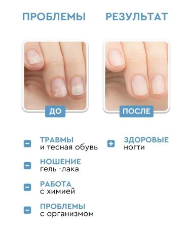 INKI Casting serum onicholysis for nail treatment 30 ml - Buy Online on GoSupps.com
