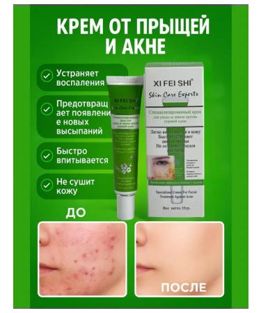 Everbloom Acne cream on the face of acne comedones on the back