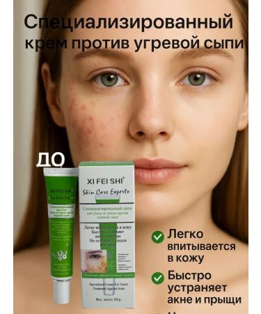 Havvamii Cream from acne for a teenager