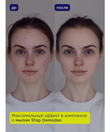 STOP Demodex Facial lotion and century with demodicosis - Buy Online on GoSupps.com