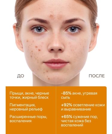 Victoria's Professional Azelainic acid for the face from acne 130 ml - Buy Online on GoSupps.com