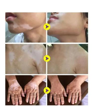 VALLEY Vitiligo cream and Vitiligo hyperpigmentation - Buy Online on GoSupps.com