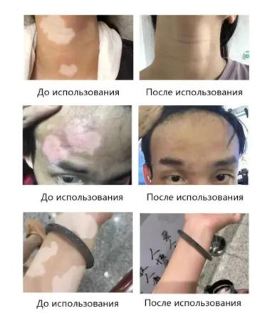 VALLEY Vitiligo cream and Vitiligo hyperpigmentation - Buy Online on GoSupps.com