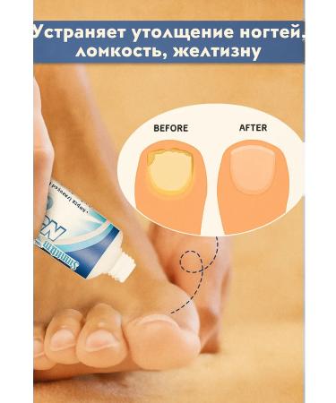 AZI BEATY Antifungal agent cream for problem nails of the foot - Buy Online on GoSupps.com