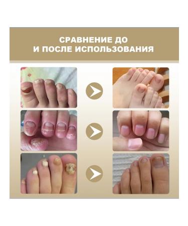OUHOE oil for nail care 2 pcs - Buy Online on GoSupps.com