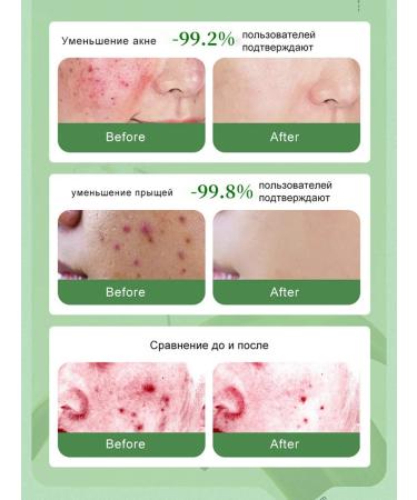 Pimples for perfect skin Facial serum - Buy Online on GoSupps.com
