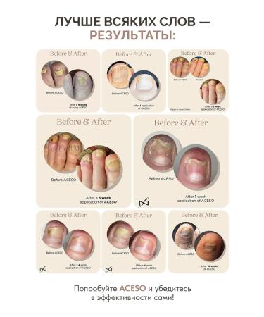 Famous Names ACESO Two -phase set for nail treatment + Debrider - Buy Online on GoSupps.com