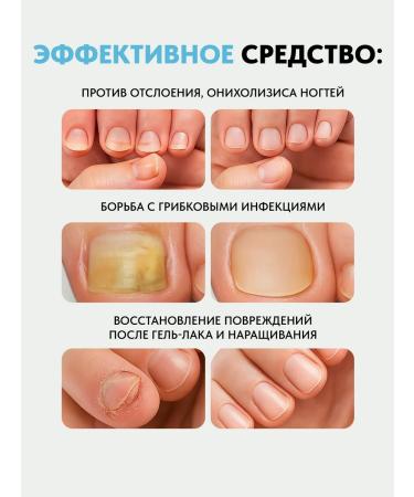 PATRISA NAIL Remedy for nail fungus on the legs of antifung 15 ml - Buy Online on GoSupps.com