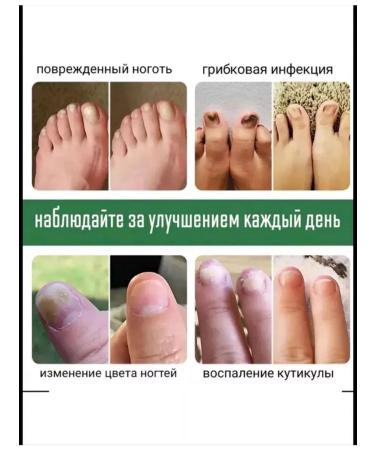 Nail fungus remedy - Buy Online on GoSupps.com