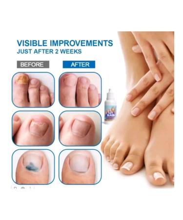 Nail fungus remedy - Buy Online on GoSupps.com
