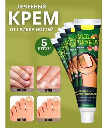 Barynch remedy for nail fungus antifungol with onycholysis