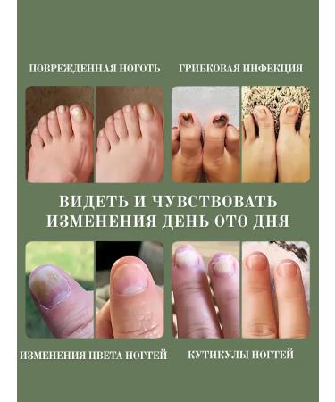 Barynch remedy for the nail fungus onholysis - Buy Online on GoSupps.com
