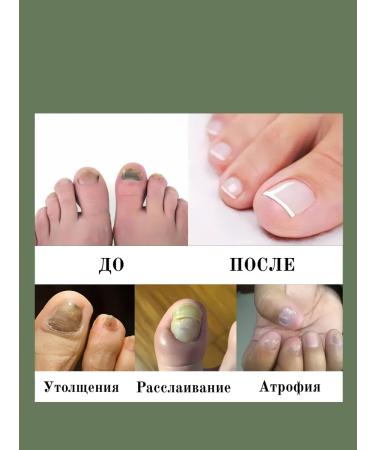 Barynch remedy for the nail fungus onholysis - Buy Online on GoSupps.com