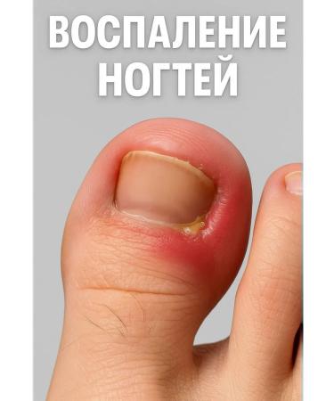 Oil for caring for inflamed areas around nails - Buy Online on GoSupps.com