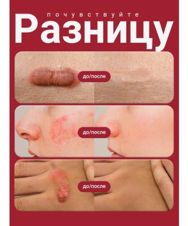 Capital pharm product Cream from scars and scars from SCAREX stretch marks - Buy Online on GoSupps.com