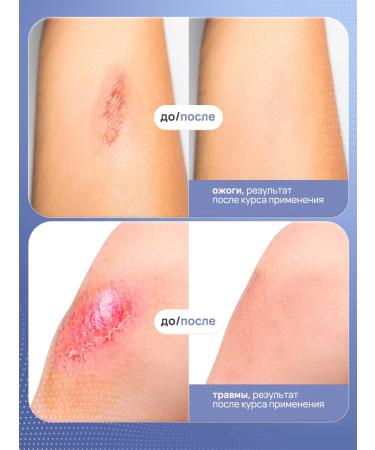 VIS MEDICUS PHARM Cream from scars and scars from stretch marks - Buy Online on GoSupps.com