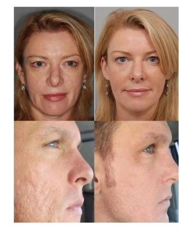 Menarini Tretinoin 0.05% Tretinoin gel from acne and wrinkles - Buy Online on GoSupps.com