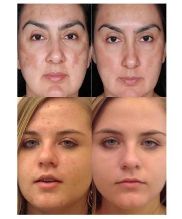 Menarini Tretinoin 0.05% Tretinoin gel from acne and wrinkles - Buy Online on GoSupps.com