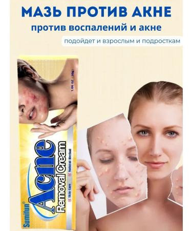 AZHAR Acne ointment and acne