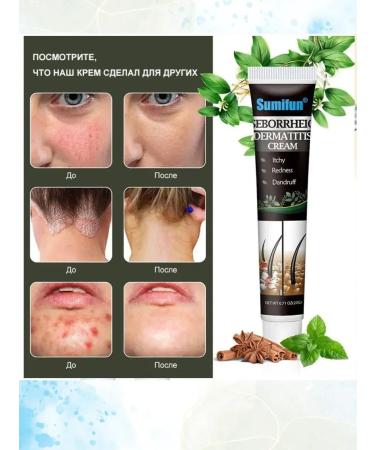 Kamielli Cream ointment from seborrheic dermatitis on the head 5 pieces - Buy Online on GoSupps.com