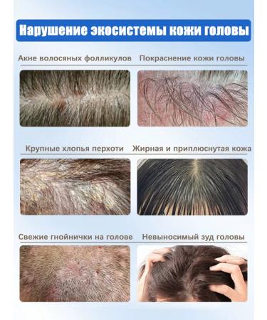Shampoo for quickly eliminating itching and dandruff - Buy Online on GoSupps.com