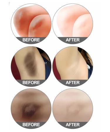 VALLEY intimate area whitening cream - Buy Online on GoSupps.com