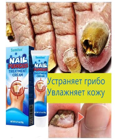 Ointment from nail fungus 20g