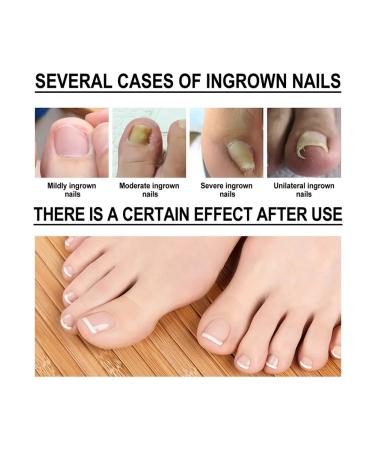 Essence for an ingrown nail 10 ml universal health n - Buy Online on GoSupps.com
