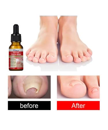 Essence for an ingrown nail 10 ml universal health n - Buy Online on GoSupps.com