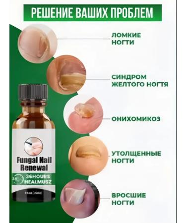 Essence Chinese remedy for nail fungus - Buy Online on GoSupps.com