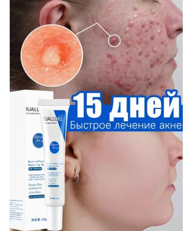 Acne acne gel and traces after them