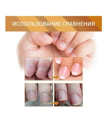 Nail fungus of the horn layer repair thickening moisturizes the gel - Buy Online on GoSupps.com