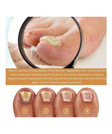 Nail fungus of the horn layer repair thickening moisturizes the gel - Buy Online on GoSupps.com
