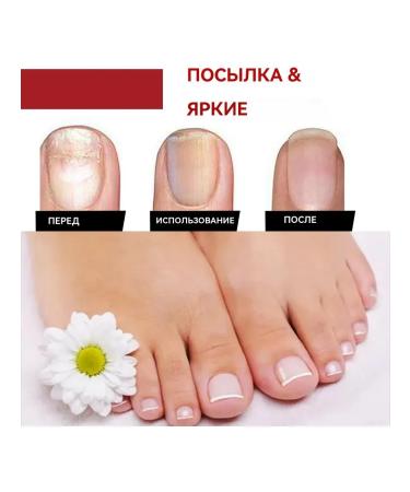 eelhoe Eliminate nail recovery fungi Delicate fluid 50 ml - Buy Online on GoSupps.com