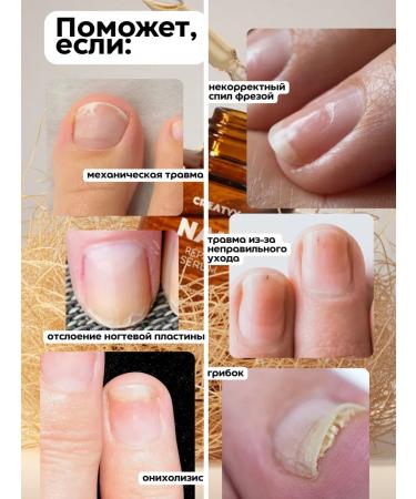 Creatyy Serum for the growth of nails against the fungus of stop onycholysis - Buy Online on GoSupps.com