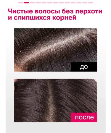 PeelinZone Piling for scalp from dandruff