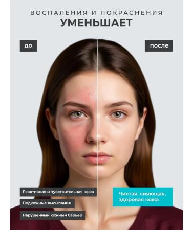 TOM WISHER Facial cream from acne acne and post -acne - Buy Online on GoSupps.com