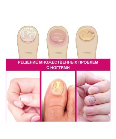 Treatment of nail fungus Care Essence exfoliating 10 ml - Buy Online on GoSupps.com
