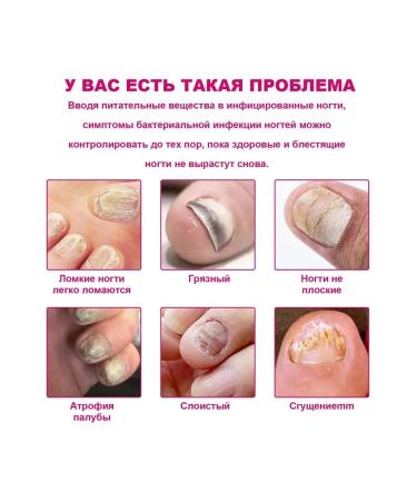 Treatment of nail fungus Care Essence exfoliating 2pcs - Buy Online on GoSupps.com