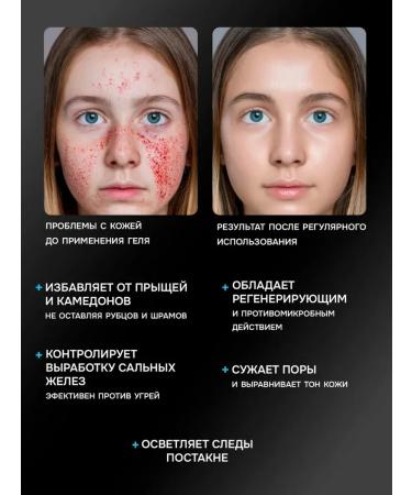 Regecin cream gel from acne acne stained acne - Buy Online on GoSupps.com